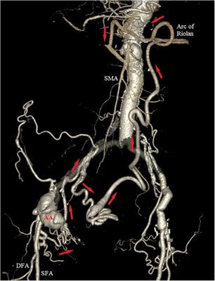 Retrograde mesenteric perfusion from the deep femoral artery in a patient with a recurrent anastomotic aneurysm in the groin: a case report
